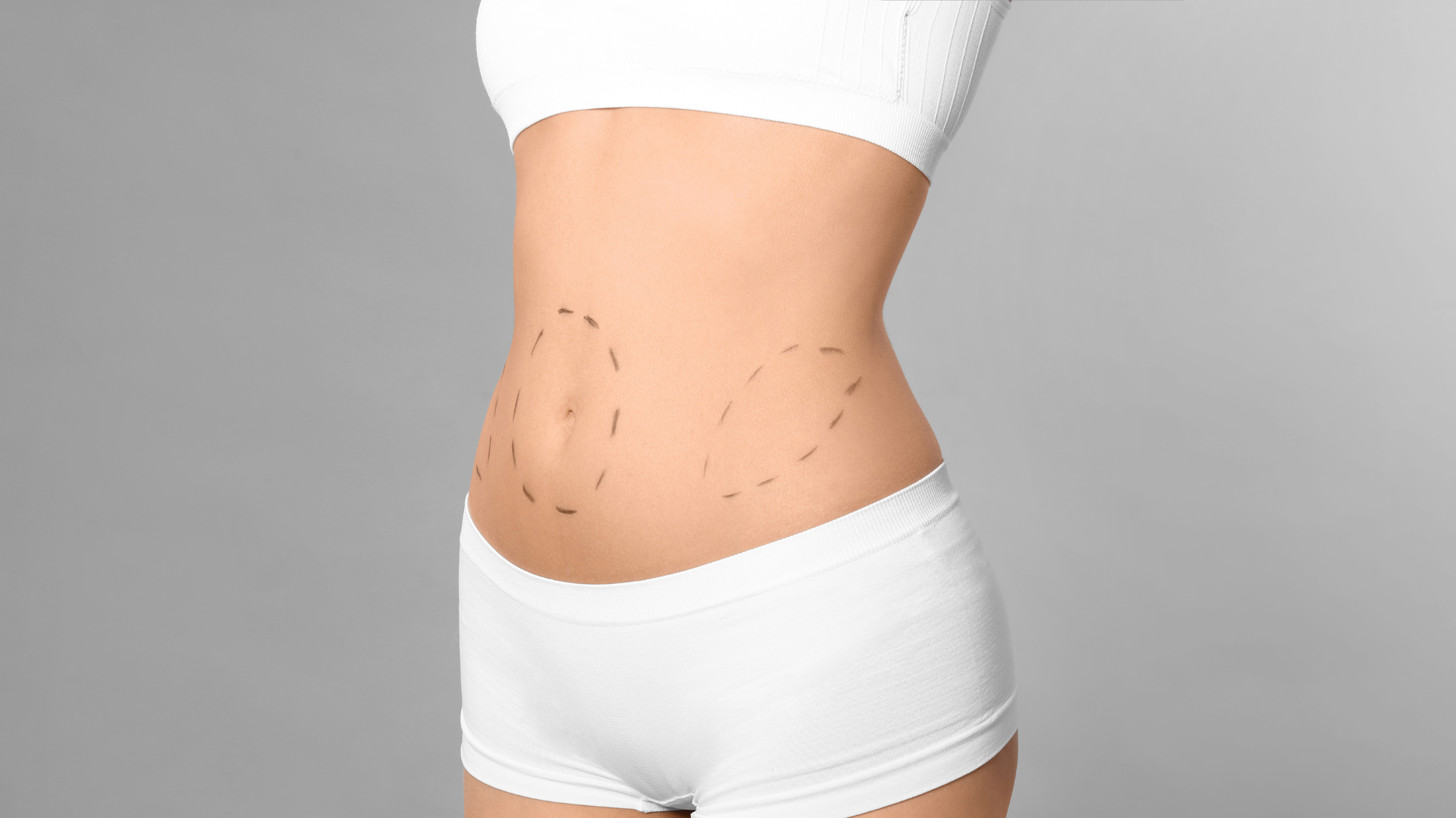 Mons Pubis Liposuction in Hollywood, FL